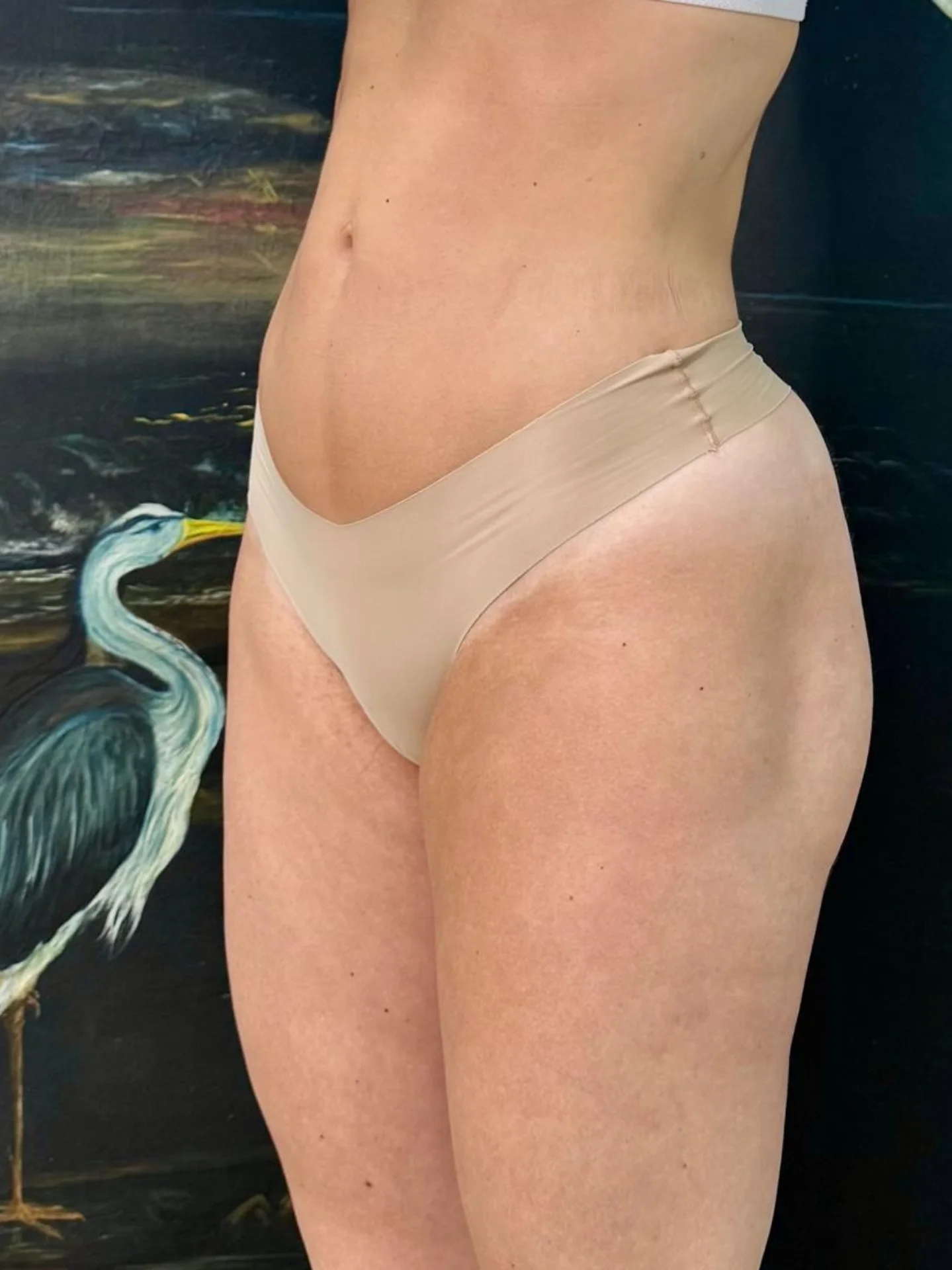 Silhouette Liposuction After